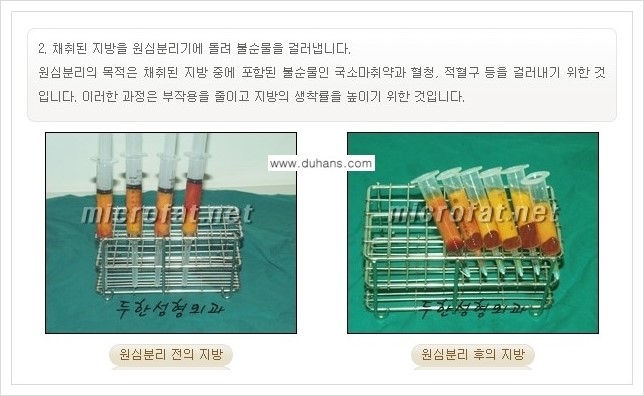 [두한성형외과 경쟁력 미세지방이식] - [부드럽고 아름다운 얼굴 윤곽선 이마(전두부) 미세지방이식] 관련 이미지 5