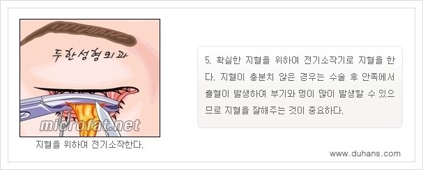[두한성형외과 경쟁력 눈밑성형] - [눈밑지방제거, 눈위지방제거 안내 1.] 관련 이미지 8