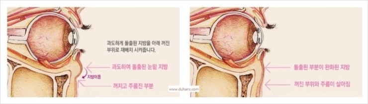 [두한성형외과 경쟁력 눈밑성형] - [다크써클의 모든 것] 관련 이미지 26
