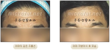이마성형 두한성형외과 - 이마주름, 이마지방이식 관련 이미지 14