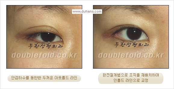 [두한성형외과 경쟁력 눈성형] - [두꺼운 아웃폴드 라인을 인폴드 라인으로 교정] 관련 이미지 3