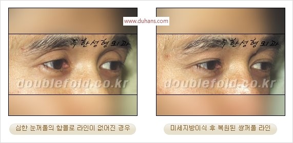 [두한성형외과 경쟁력 쌍꺼풀 재수술 리더] - [풀린 쌍꺼풀, 풀려버린 쌍꺼풀 재수술 방법 안내] 관련 이미지 10