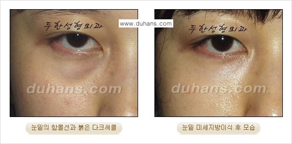 [두한성형외과 경쟁력 미세지방이식] - [다크써클 & 눈밑주름 미세지방이식 4.] 관련 이미지 11
