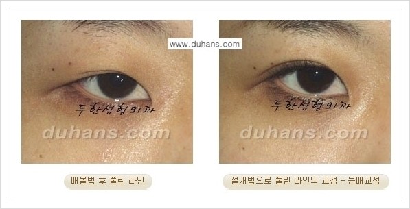 [두한성형외과 경쟁력 쌍꺼풀 재수술, 극한 재수술] - [풀려버린 쌍꺼풀 라인의 교정 방법 안내] 관련 이미지 4