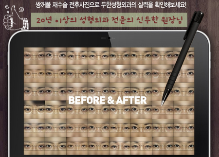 [Duhan Plastic Surgery Double Eyelid Revision Surgery] - [Asymmetric Eye Correction, Thick Ptosis, Lateral and Lower Canthoplasty] image 90
