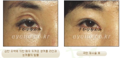Duhan Plastic Surgery Ophthalmic Reoperation - What Is a Successful Double Eyelid Revision Surgery? image 7
