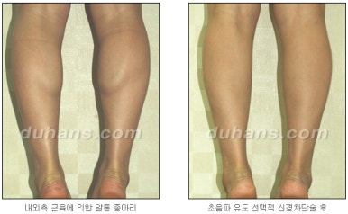 [두한성형외과 종아리 퇴축] - [종아리 퇴축술 재발 재수술] 관련 이미지 22