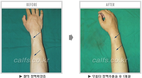 [종아리성형 두한성형외과] - [종아리수술에 대한 자주하는 질문과 답변 모음] 관련 이미지 52