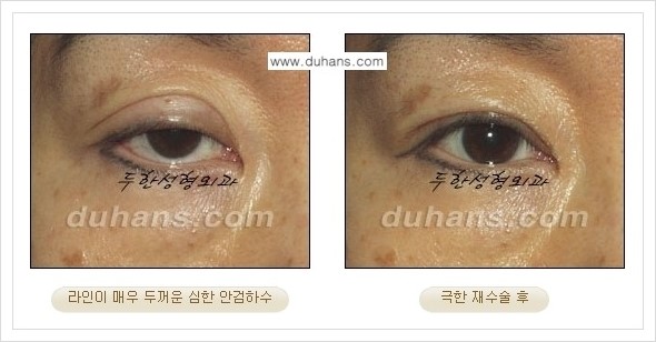 [두한성형외과 경쟁력 망가진 눈 복원수술] - [두꺼운 라인을 교정하는 극한 재수술(Extreme Reoperation) 안내] 관련 이미지 12