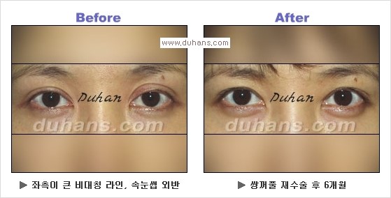 [두한성형외과 경쟁력 눈성형] - [Dr. 컬럼  "어떤 쌍꺼풀이 아름다운 쌍꺼풀인가?!] 관련 이미지 11