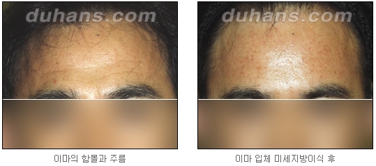 [두한성형외과 주름교정] - [주름개선 지방이식] 관련 이미지 13