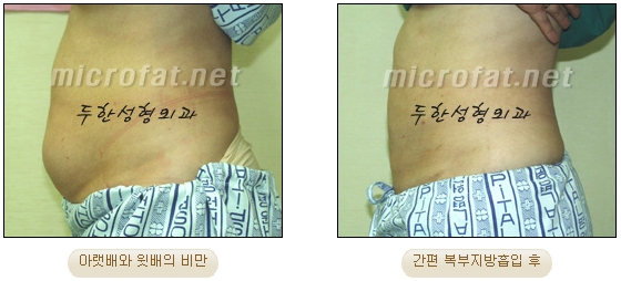 두한성형외과 지방흡입 - 부위별 안전 지방흡입 관련 이미지 16