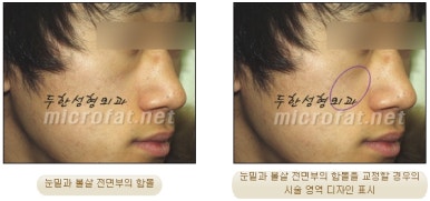 [Duhan Plastic Surgery Face Autologous Fat Grafting] - [Noble Surgery and Indian Band Fat Grafting] image 10