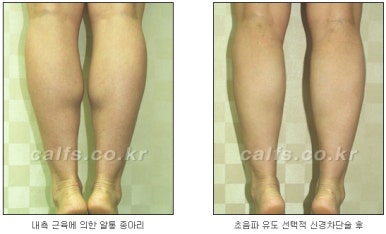 ​[두한성형외과 종아리수술] - [나에게 맞는 종아리성형방법] 관련 이미지 9