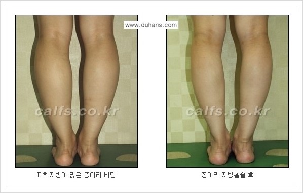 [두한성형외과 경쟁력 멀티종아리성형] - [정교한 미세흡입관 종아리 지방흡입술] 관련 이미지 12