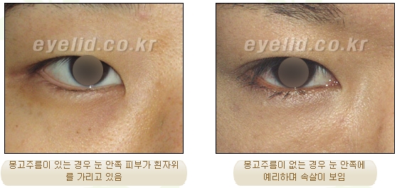 [두한성형외과 쌍커풀수술] - [눈성형 방법에 대한 자주하는 질문과 답변] 관련 이미지 139