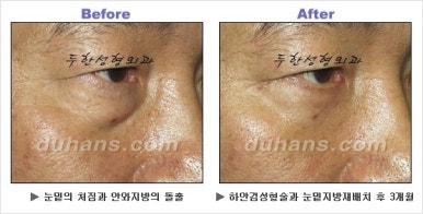 [두한성형외과 안검성형] - [상안검, 하안검] 관련 이미지 62