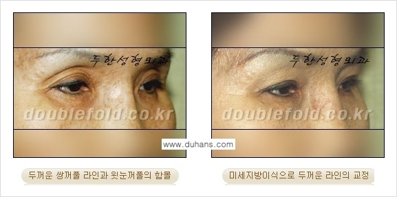 [두한성형외과 경쟁력 눈성형] - [미세지방이식으로 두꺼운 쌍꺼풀 라인의 교정 방법 안내] 관련 이미지 10