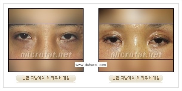 ⁠[두한성형외과 경쟁력 미세지방이식] - [미세지방이식의 부작용 문제 교정 안내] 관련 이미지 7