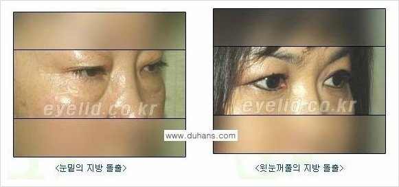 [두한성형외과 경쟁력 안검성형] - [젊어 보이면서 개선된 인상을 주기 위한 성형] 관련 이미지 37