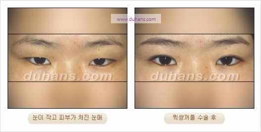 [두한성형외과 경쟁력 눈성형] - [자연스럽고 아름다운 눈매를 만드는 여러 가지 눈성형 방법] 관련 이미지 17