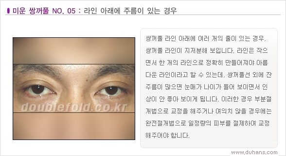 [두한성형외과 경쟁력 쌍꺼풀 재수술, 극한 눈재수술] - [Dr. 컬럼 - 재수술의 목표] 관련 이미지 8