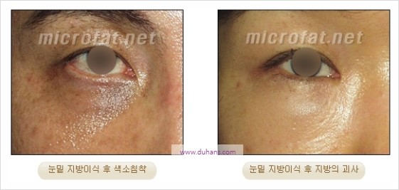 [두한성형외과 경쟁력 지방이식] - [두한 자가지방이식 클리닉 안내]​ 관련 이미지 60