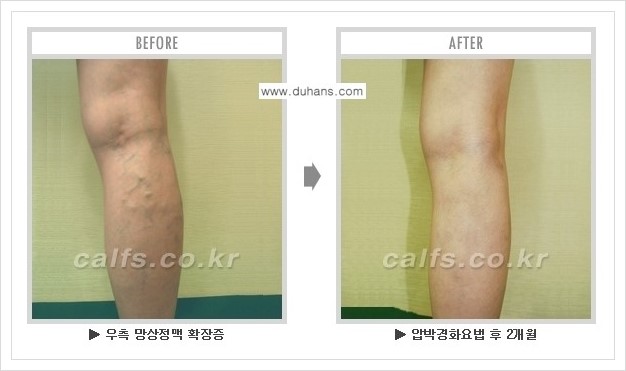 [두한성형외과 경쟁력 멀티종아리성형] - [하지정맥류 치료 안내] 관련 이미지 11