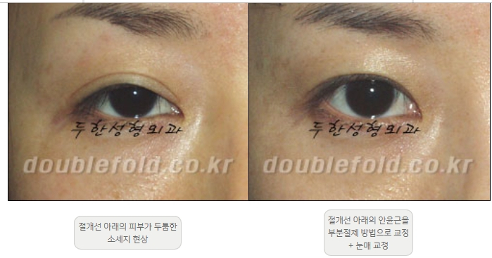 [Double Eyelid Surgery Duhan Plastic Surgery] - [Revision Methods] image 15