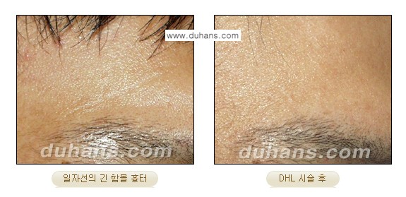 [두한성형외과 흉터 교정] - [함몰흉터의 DHC 시술] 관련 이미지 14