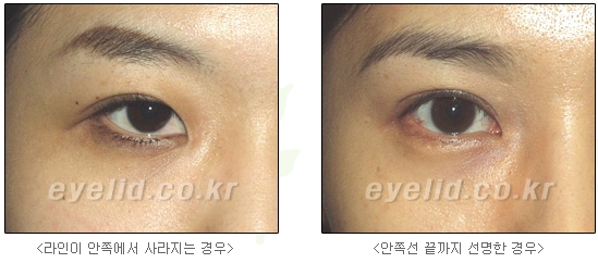 쌍커풀수술 두한성형외과 - 나에게 맞는 눈성형은? 관련 이미지 10
