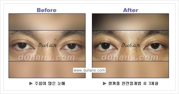 [두한성형외과 경쟁력 눈성형] - [퀵쌍꺼풀 수술 전후 정보 안내 ②] 관련 이미지 9