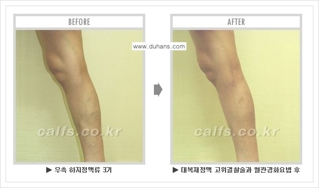[두한성형외과 경쟁력 멀티종아리성형] - [하지정맥류 치료 안내] 관련 이미지 7