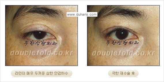 [두한성형외과 경쟁력 쌍꺼풀 재수술, 극한 눈재수술] - [망친 쌍꺼풀을 복원하는 극한 눈재수술] 관련 이미지 16