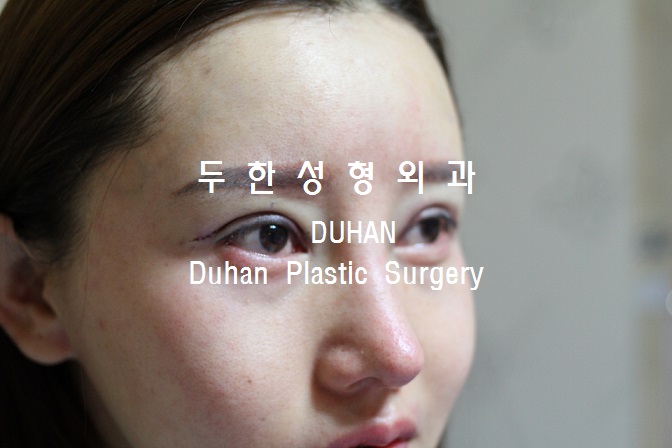 큰 아웃라인,#안검하수 #눈재수술, #애교살 #지방이식 관련 이미지 6