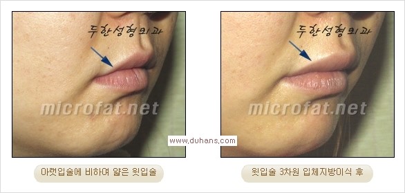 [두한성형외과 경쟁력 미세지방이식] - [입술 3차원 입체지방이식 안내 1.] 관련 이미지 13