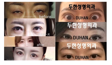 과교정 눈매 (소세지 쌍커풀 재수술, 눈매교정 재수술) 관련 이미지 4