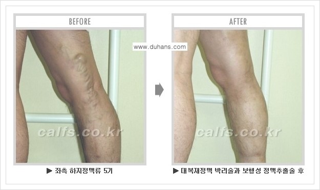 [두한성형외과 경쟁력 멀티종아리성형] - [하지정맥류 치료 안내] 관련 이미지 9