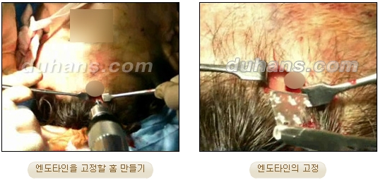 두한성형외과 안티에이징 리프팅 - 엔도타인 리프팅 관련 이미지 26
