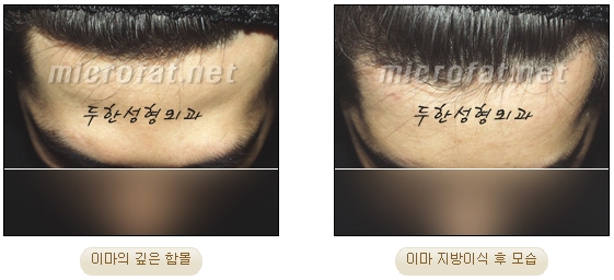 [두한성형외과 이마성형] - [엔도타인리프팅, 이마지방이식]​ 관련 이미지 34