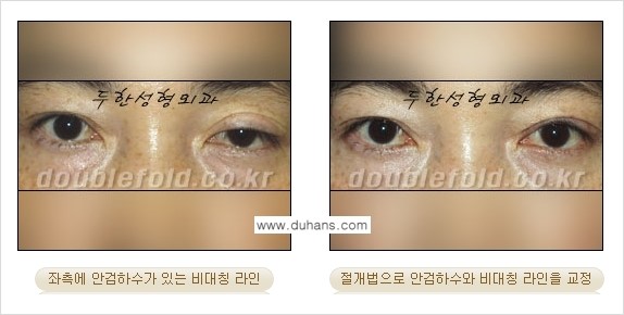 [두한성형외과 NO.1 "극한 눈(쌍꺼풀 재수술)"] - [안검하수(졸린눈매) 재수술 안내 3.] 관련 이미지 11