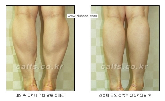 [두한성형외과 경쟁력 종아리성형] - [초음파 유도 선택적 신경차단술 안내 ③] 관련 이미지 12