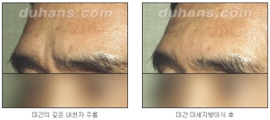 [두한성형외과 주름교정] - [지방이식을 이용한 주름개선] 관련 이미지 13