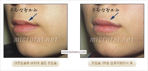 ​​​[두한성형외과 경쟁력 지방이식] - [지방이식을 이용한 입술성형 안내] 관련 이미지 12