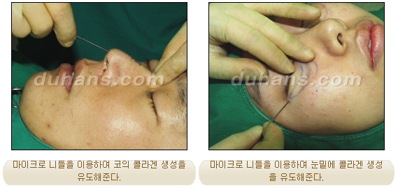 [Duhan Plastic Surgery Facial Autologous Fat Grafting] - [Fat Grafting Guide] image 19