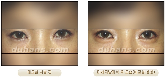 Duhan Plastic Surgery Under-Eye Surgery - Correction with Fat Grafting After Aegyo-Sal Filler image 10
