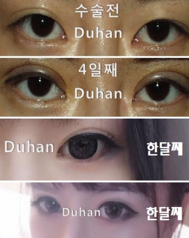 [DuHan Plastic Surgery Double Eyelid Surgery] - [Frequently Asked Questions and Answers About Eye Plastic Surgery] image 5