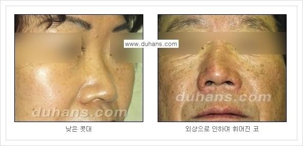 [두한성형외과 경쟁력 미세지방이식] - [코 미세지방이식 안내] 관련 이미지 2