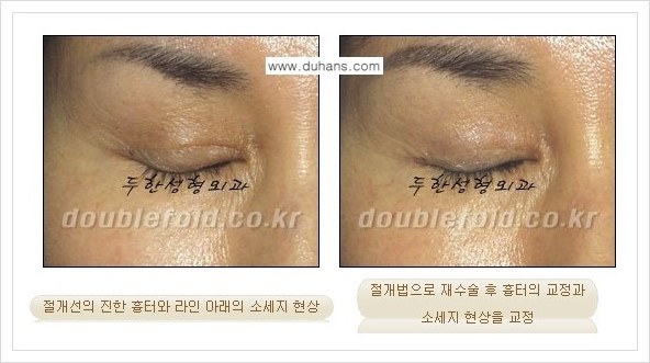 [두한성형외과 경쟁력 쌍꺼풀(눈) 재수술] - [쌍꺼풀 흉터선이 진한 경우의 안내] 관련 이미지 3