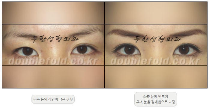 [두한성형외과 쌍커플재수술] - [비대칭 쌍커풀 라인] 관련 이미지 6